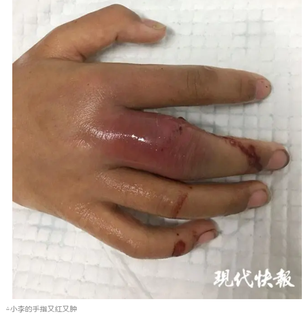 手指伤口感染肿胀图片图片